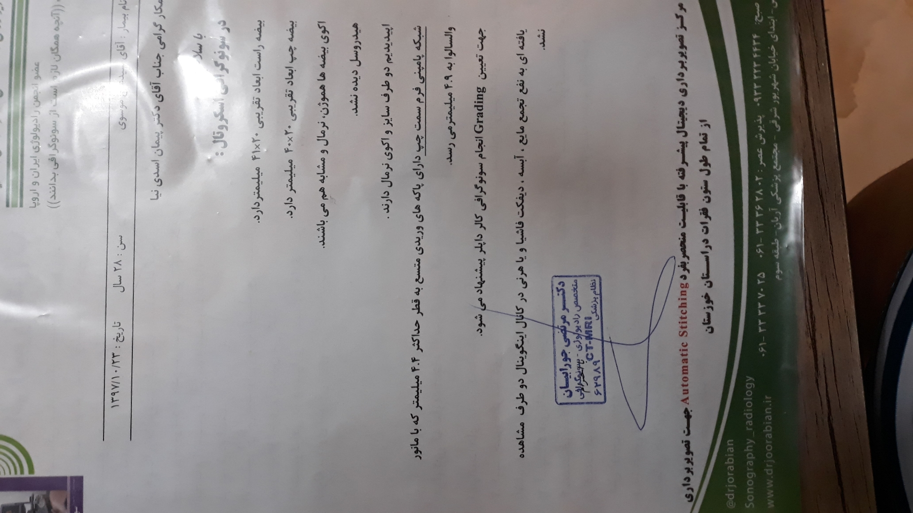 واریکوسل یک طرفه