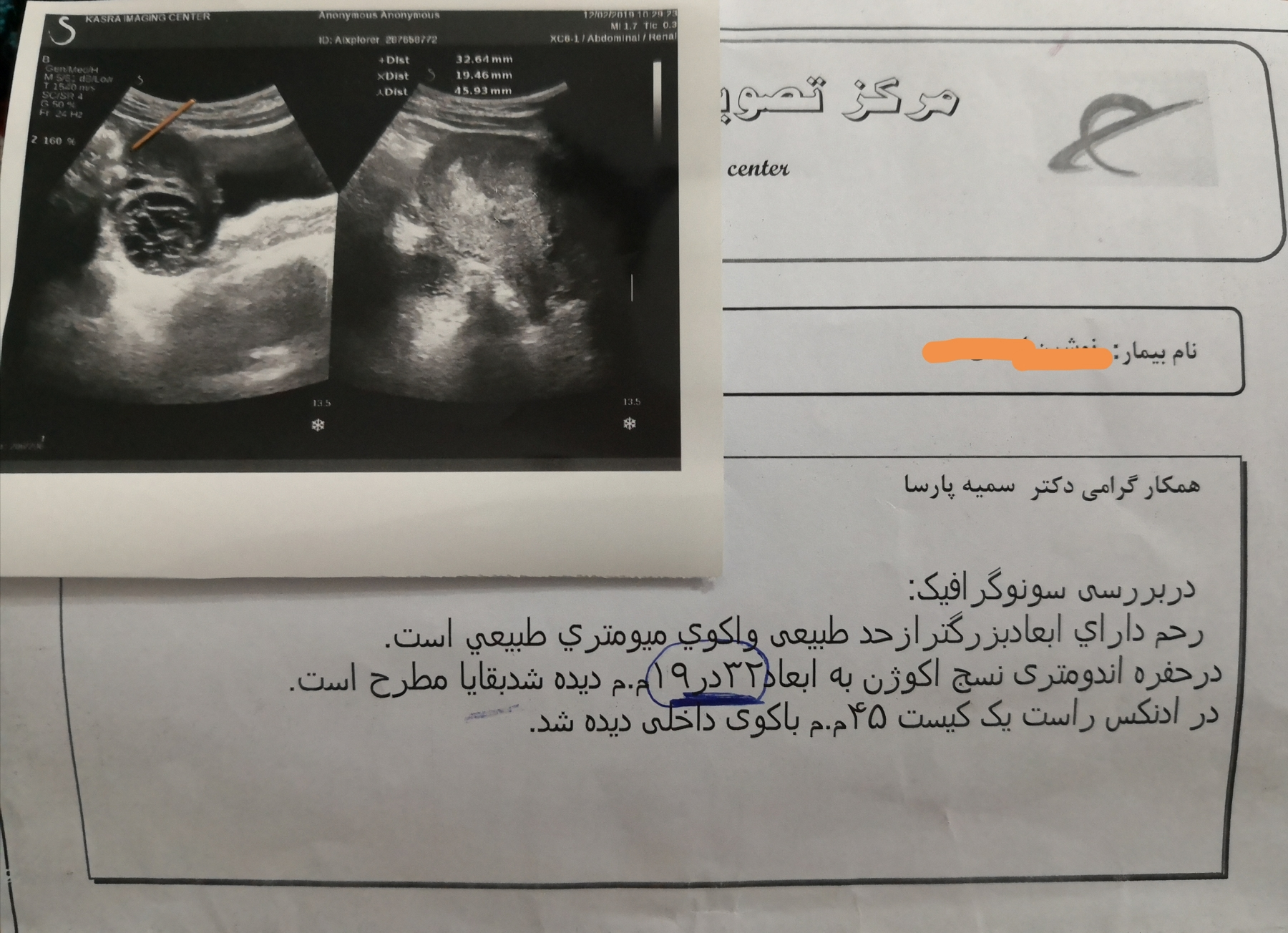 مول در رحم بعد از سقط