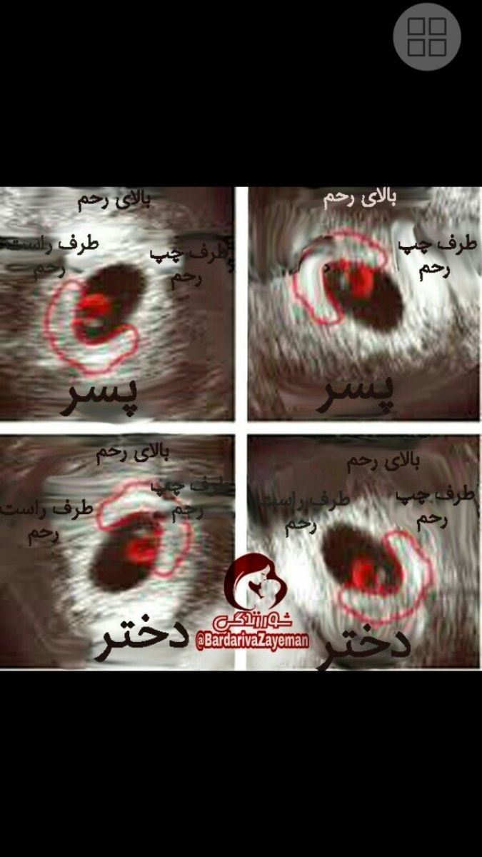 احتمال خطاجنسیت در سونوی ntچقدره؟