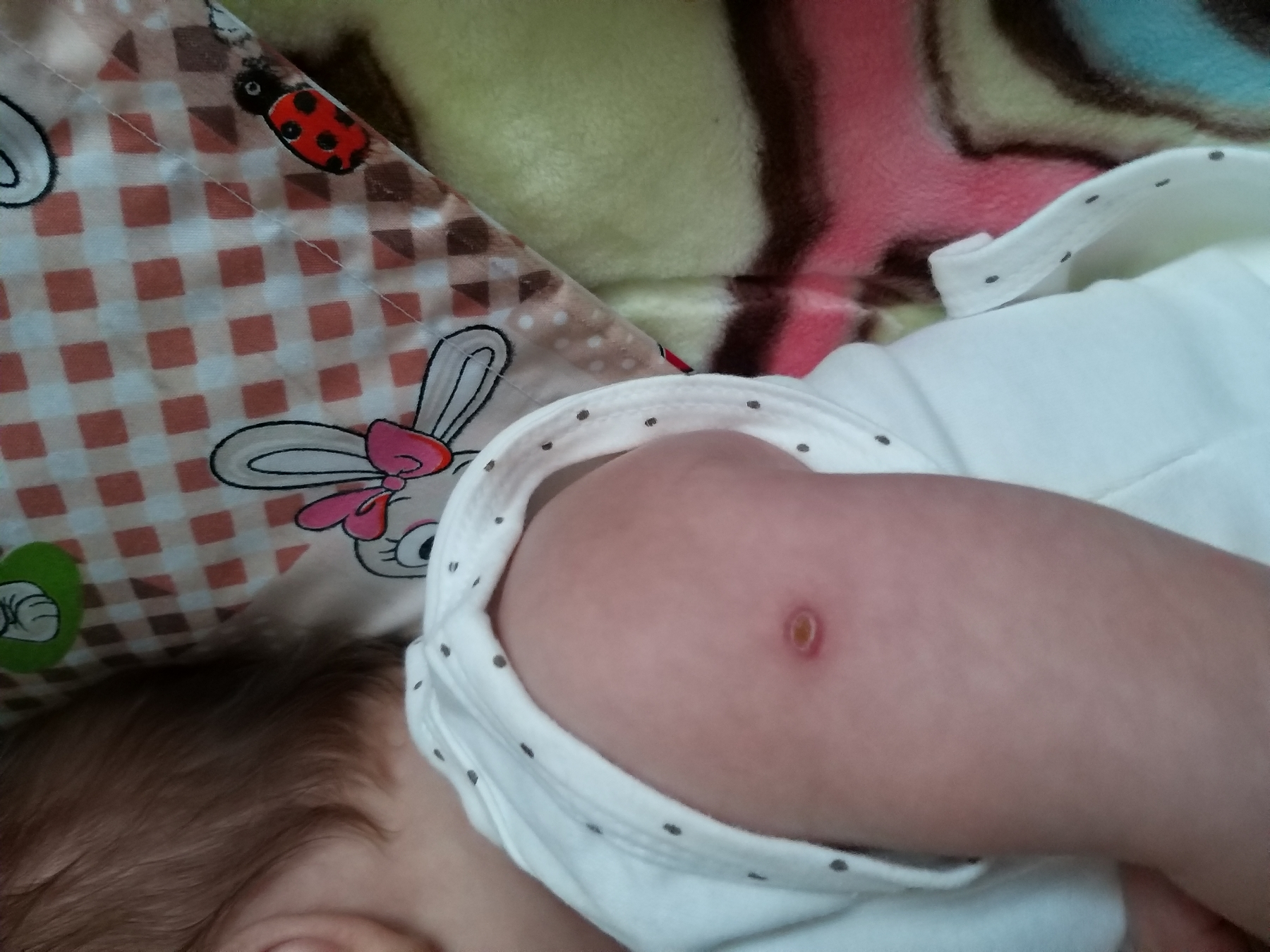 عفونت کردن جای واکسن پسرم عفونت کردن جای واکسن پسرم