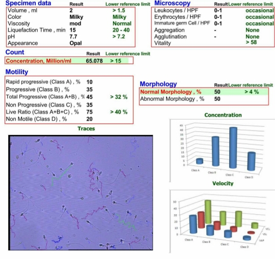 تفسیر آزمایش نمونه اسپرم