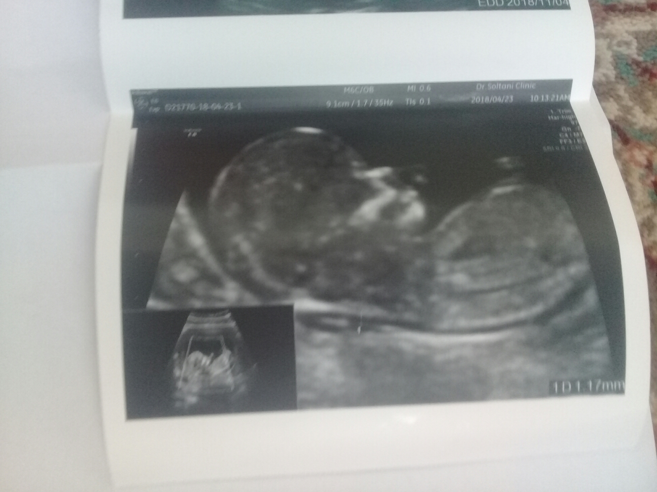 تفسیر سونوی غربالگری اول تفسیر سونوی غربالگری اول