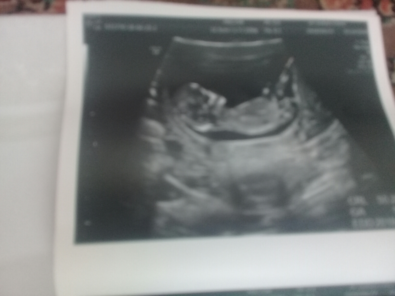 تفسیر سونوی غربالگری اول تفسیر سونوی غربالگری اول