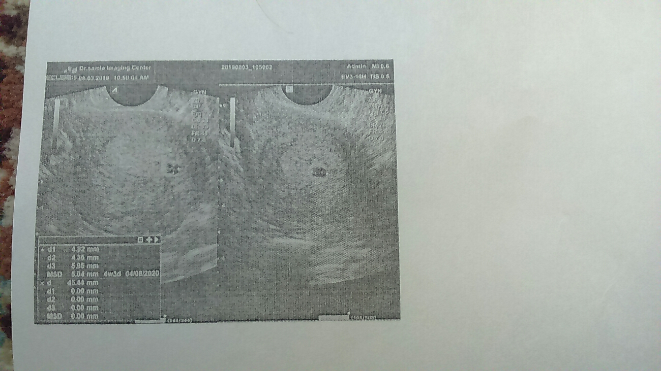 تفسیر سونوگرافی سقط جنین تفسیر سونوگرافی سقط جنین