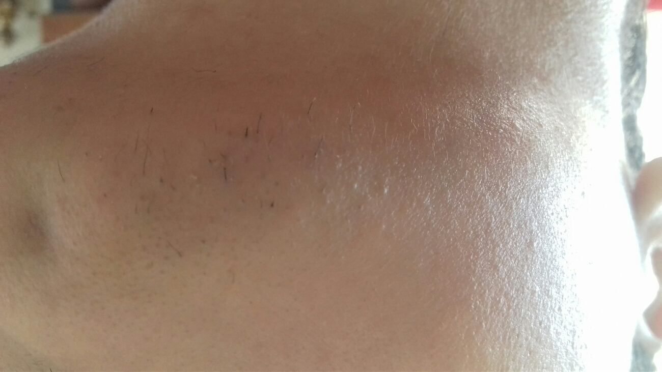 رشدمو زیاد زیرچونه وبالای لب وناباوری رشدمو زیاد زیرچونه وبالای لب وناباوری