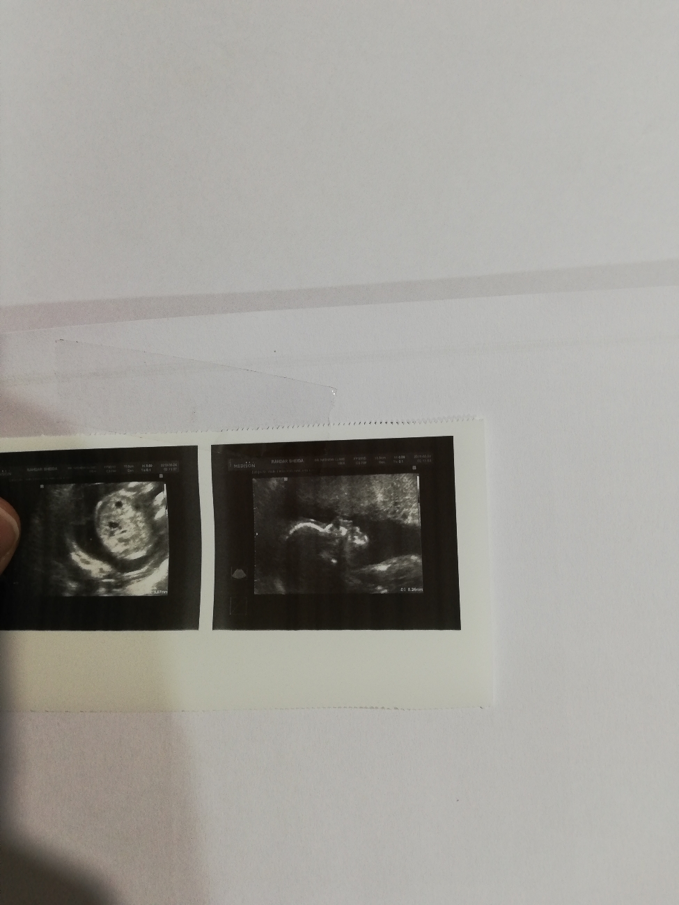 جواب آنومالی جنین پسر جواب آنومالی جنین پسر