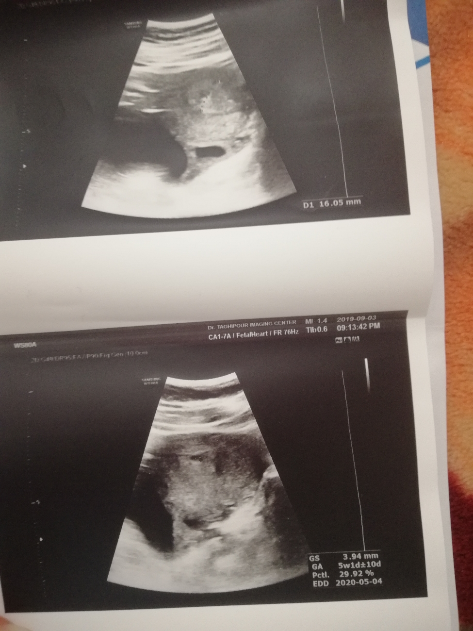 سقط پنج هفته و یک روز