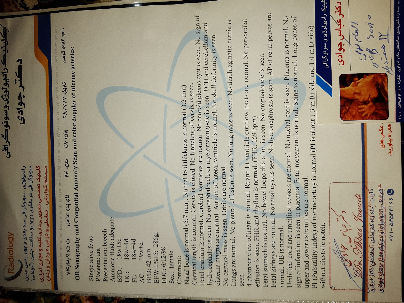 سونوگرافی آنومالی وسلامت جنین