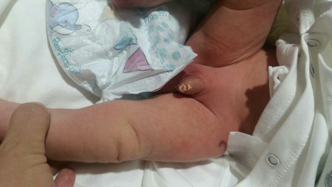 علت ترشح زرد از آلت نوزاد پسر چیست ؟