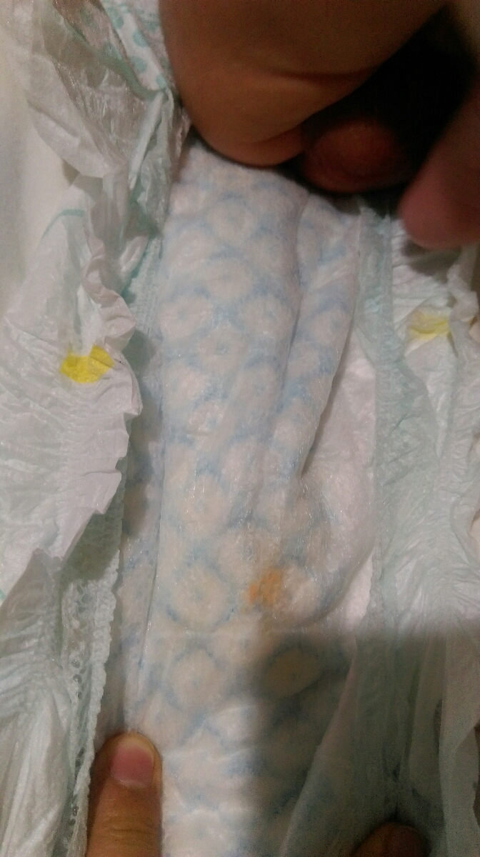 علت ترشح زرد از آلت نوزاد پسر چیست ؟