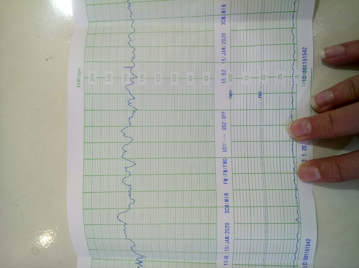 نوار قلب در ۳۷ هفتگی