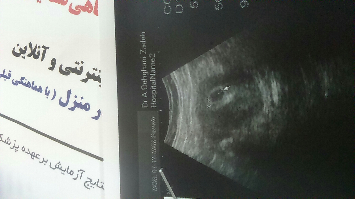 سونو هفته ششم بارداری