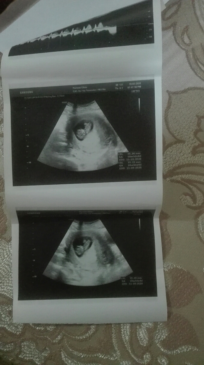 بچه ها ی لحظه بیاین ،امروز لک دیدم رفتم سونو ....