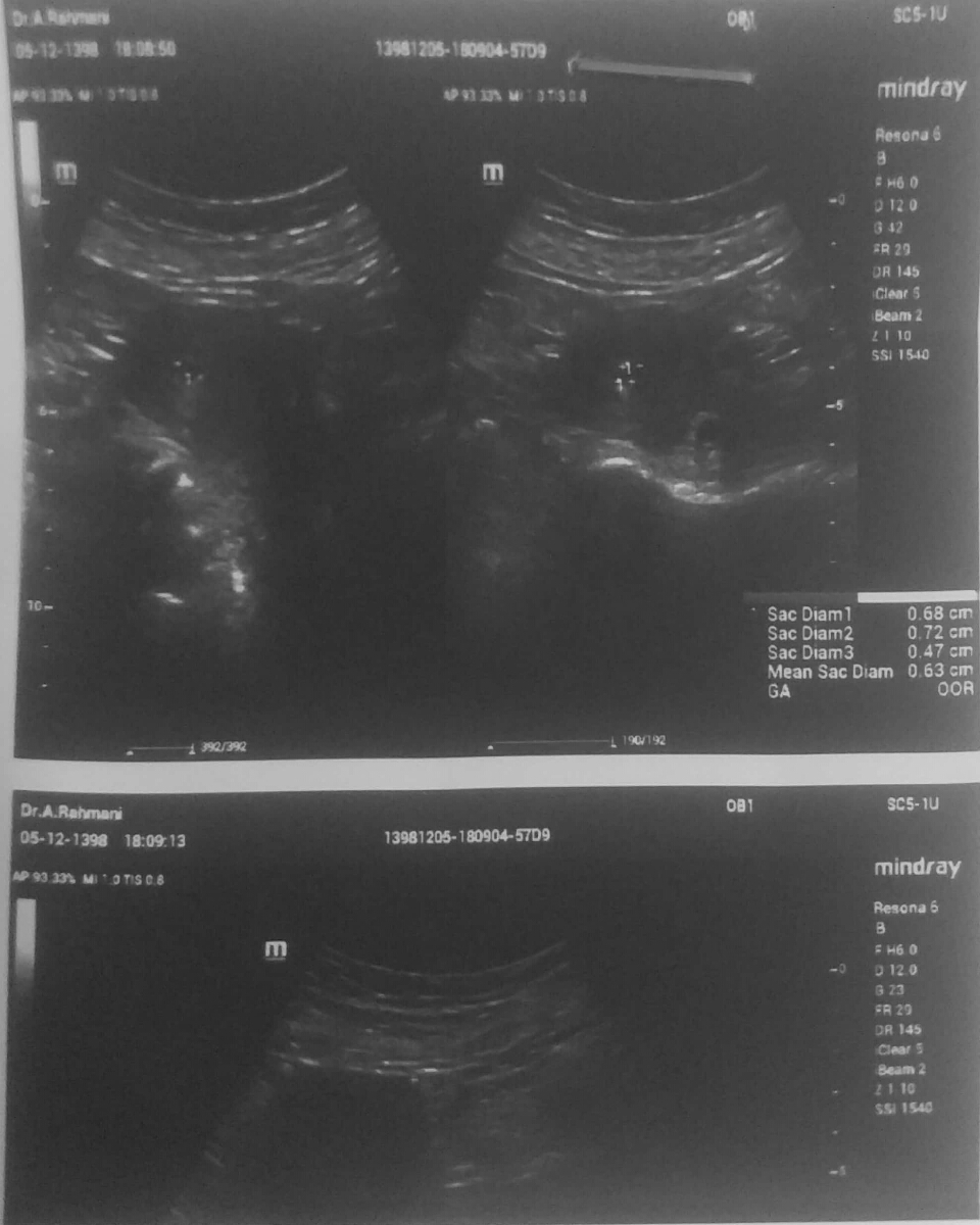 چرا سونو اول 12 هفته هستم و وجود جنین و سونو سلامت , کیسه خالی از جنین و 6 هفته هست سن کیسه؟؟؟؟؟