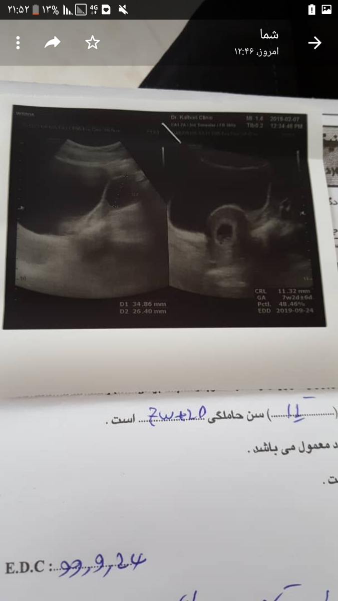 کیست تخمدان در بارداری ۷ هفتگی