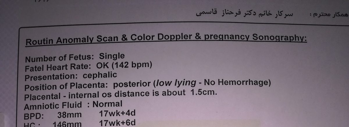 جفت پایین یا low lying