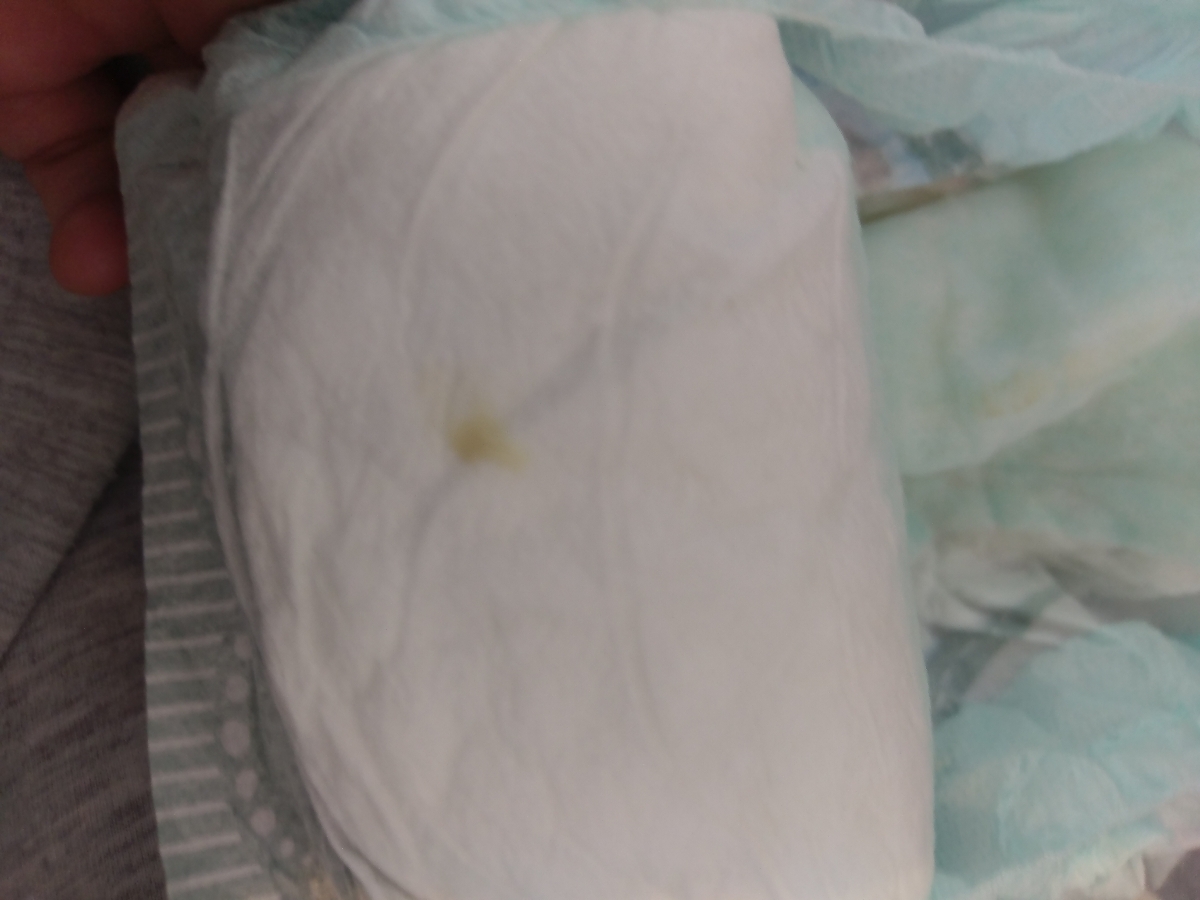 ترشح نوزاد 6 ماهه