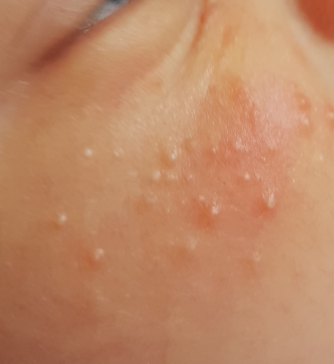 دلیل این جوش ها روی گونه دخترم چیه+عکس دلیل این جوش ها روی گونه دخترم چیه+عکس