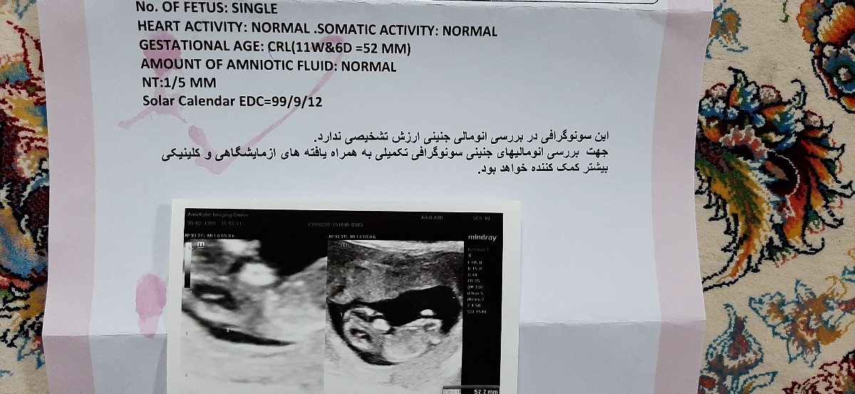 تفسیر آزمایش غربالگری NT