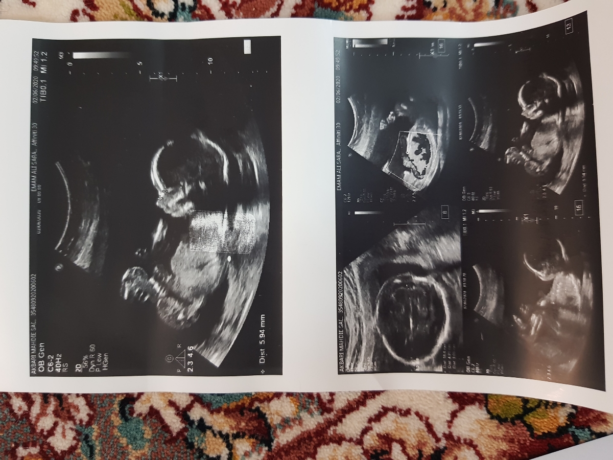 سونوی آنومالی ...لطفا بیاین