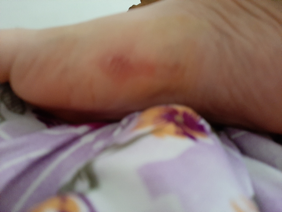 تاول زدم چیکار کنم خوب شع🤷‍♀️😭😭😭😭همراه عکس