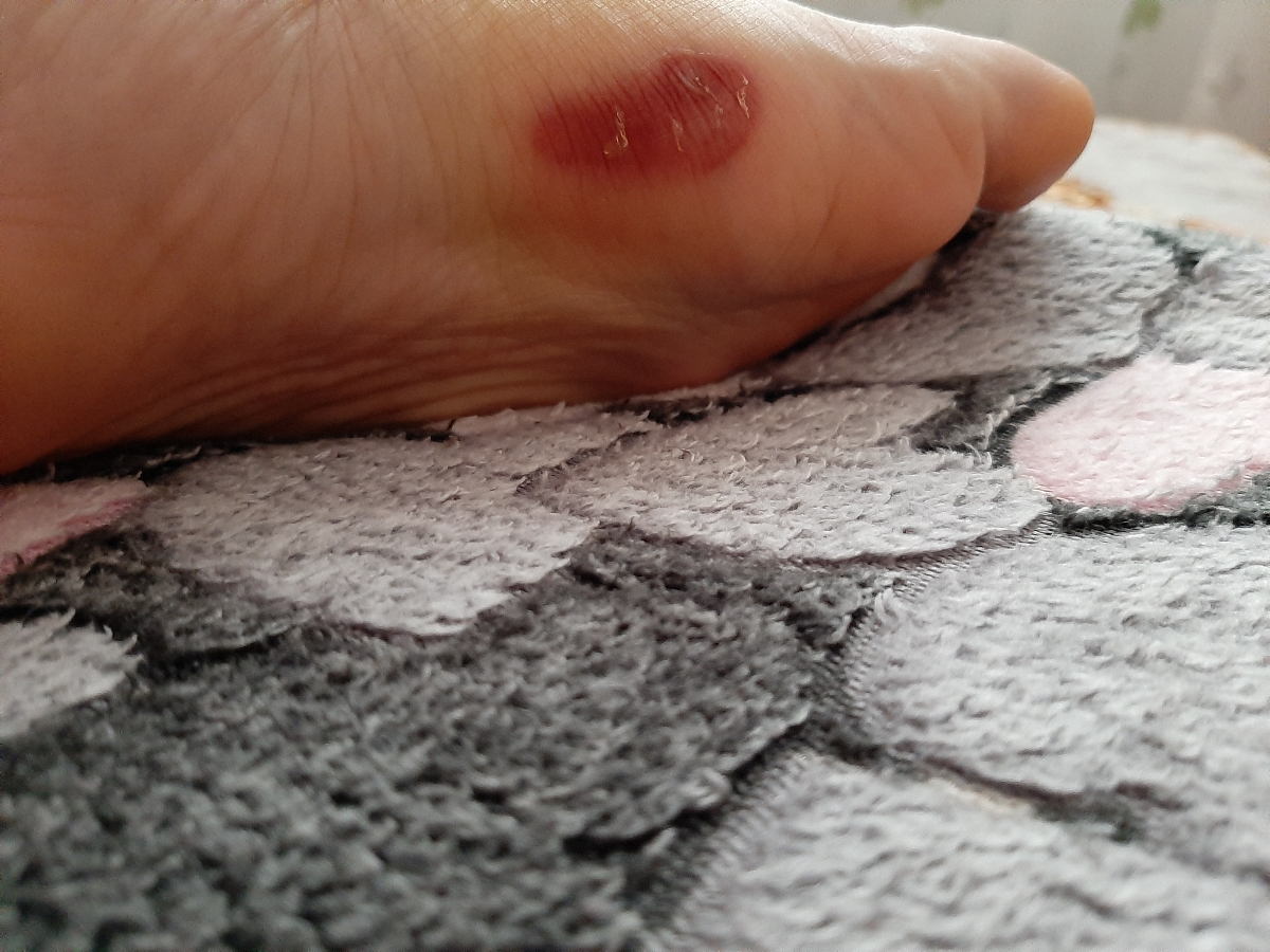 تاول زدم چیکار کنم خوب شع🤷‍♀️😭😭😭😭همراه عکس