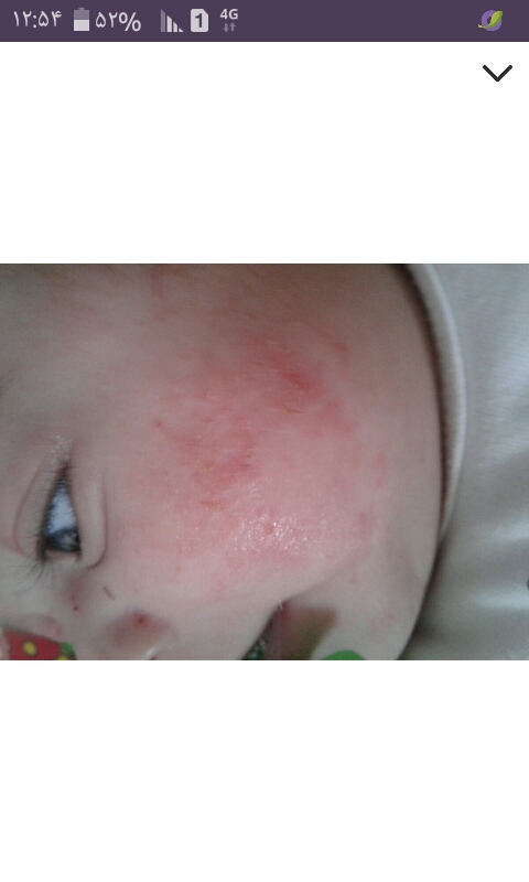 مشکل پوست نوزاد ۴ ماهه