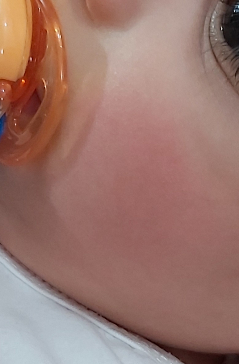 قرمز شدن لپ کودک