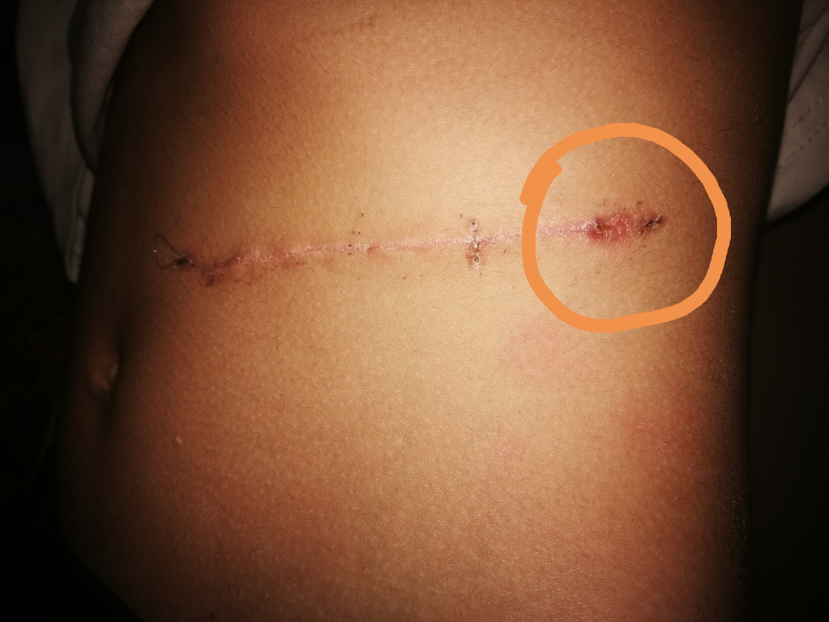 ورم بخیه سزارین