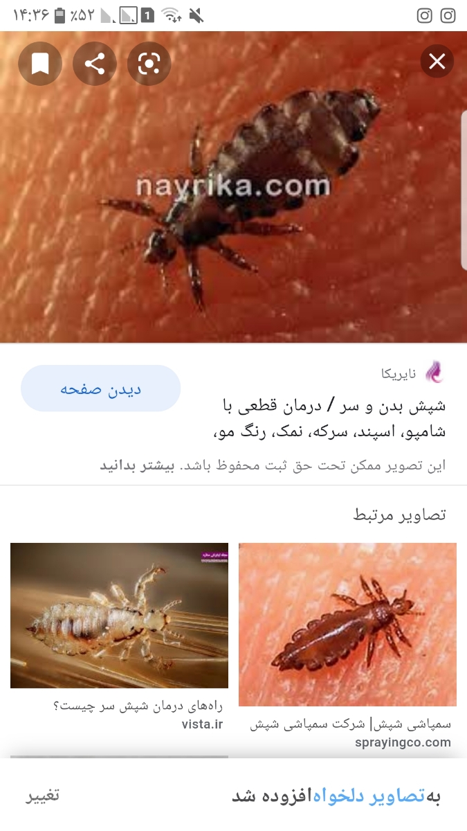 شپش سر نوزاد ۴ماهه