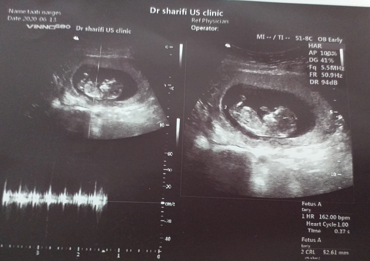 سونوی ان تی وحدس جنسیت سونوی ان تی وحدس جنسیت