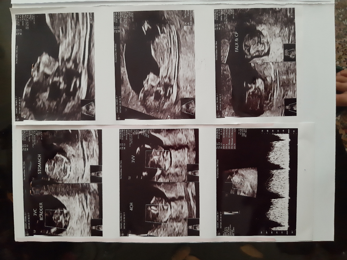 سونوی ان تی وحدس جنسیت سونوی ان تی وحدس جنسیت