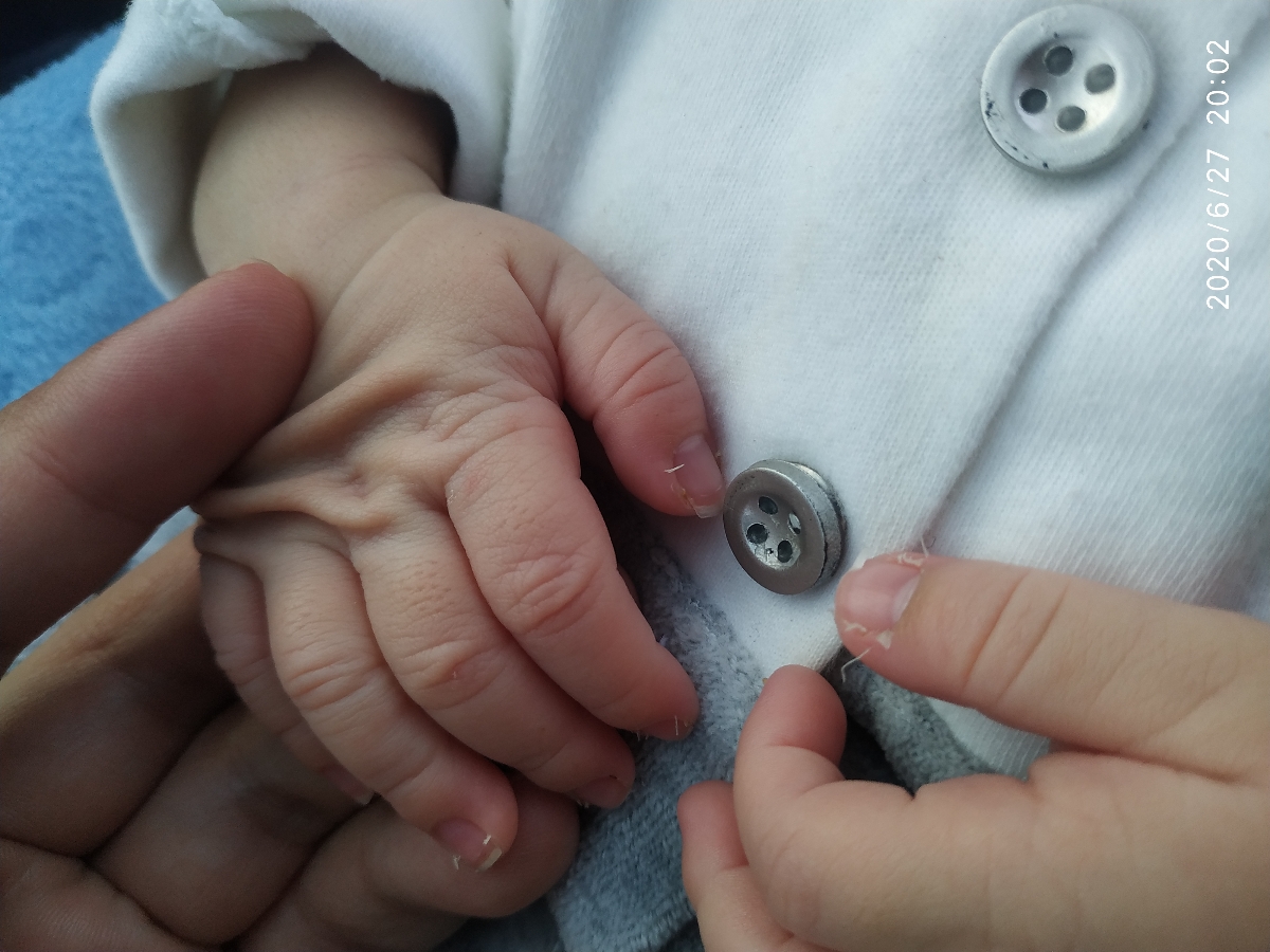 ناخونا بچم کنارشون پوست انداخته ناخونا بچم کنارشون پوست انداخته