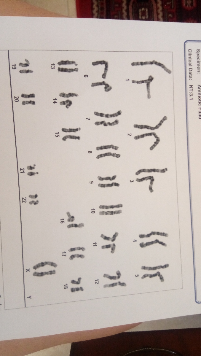 سوال درباره نوع کروموزوم دوقلو دختر
