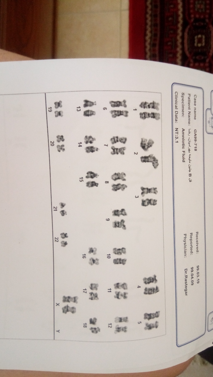 سوال درباره نوع کروموزوم دوقلو دختر