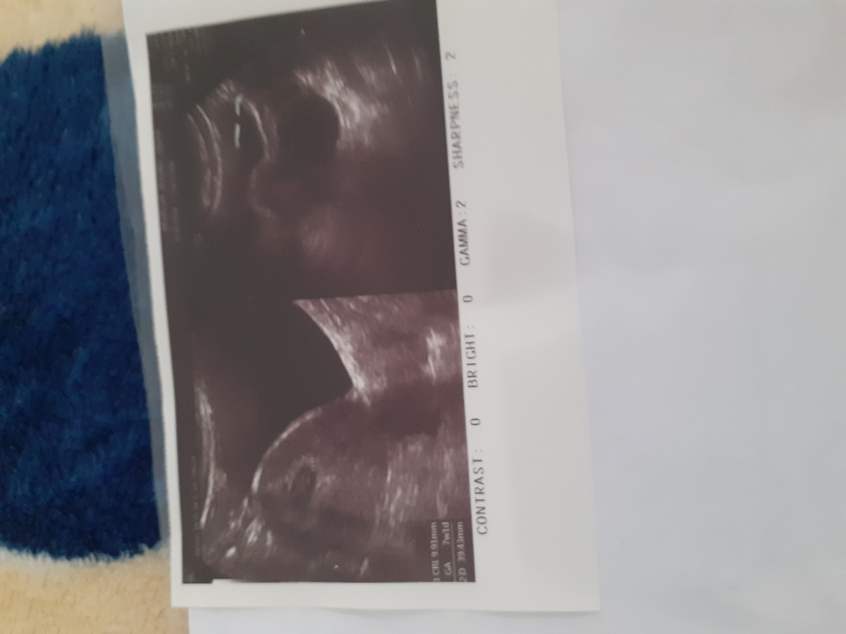 عایا سونوگرافیم همه چی طبیعی است؟