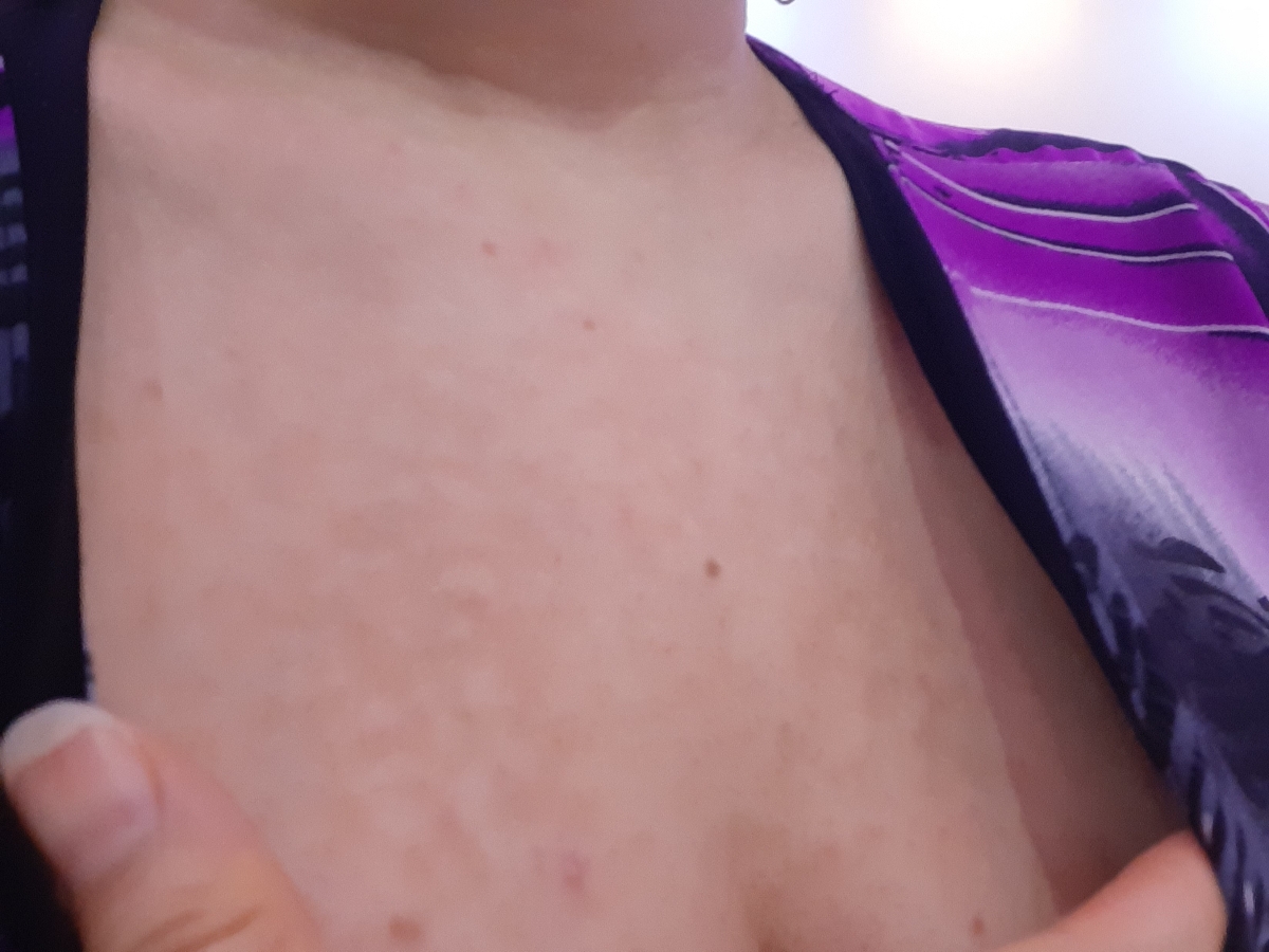 لک پوست بالای سینه