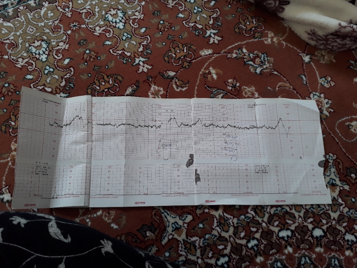 نشت کردن مایع امنیوتیک