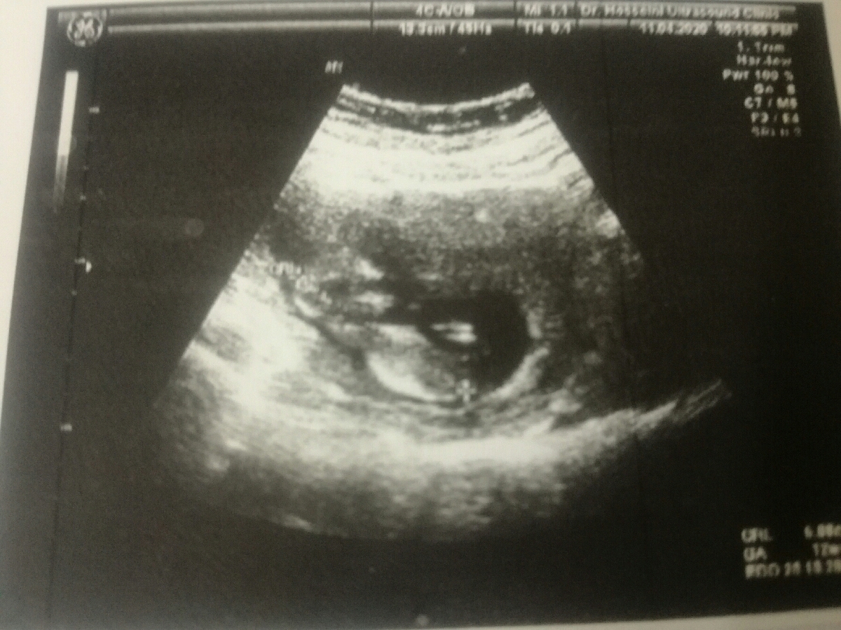 سونو انومالی .