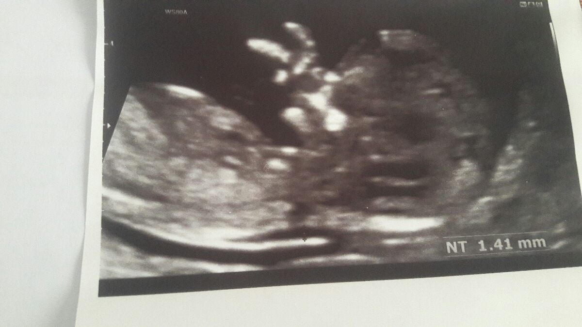 سونو انومالی .