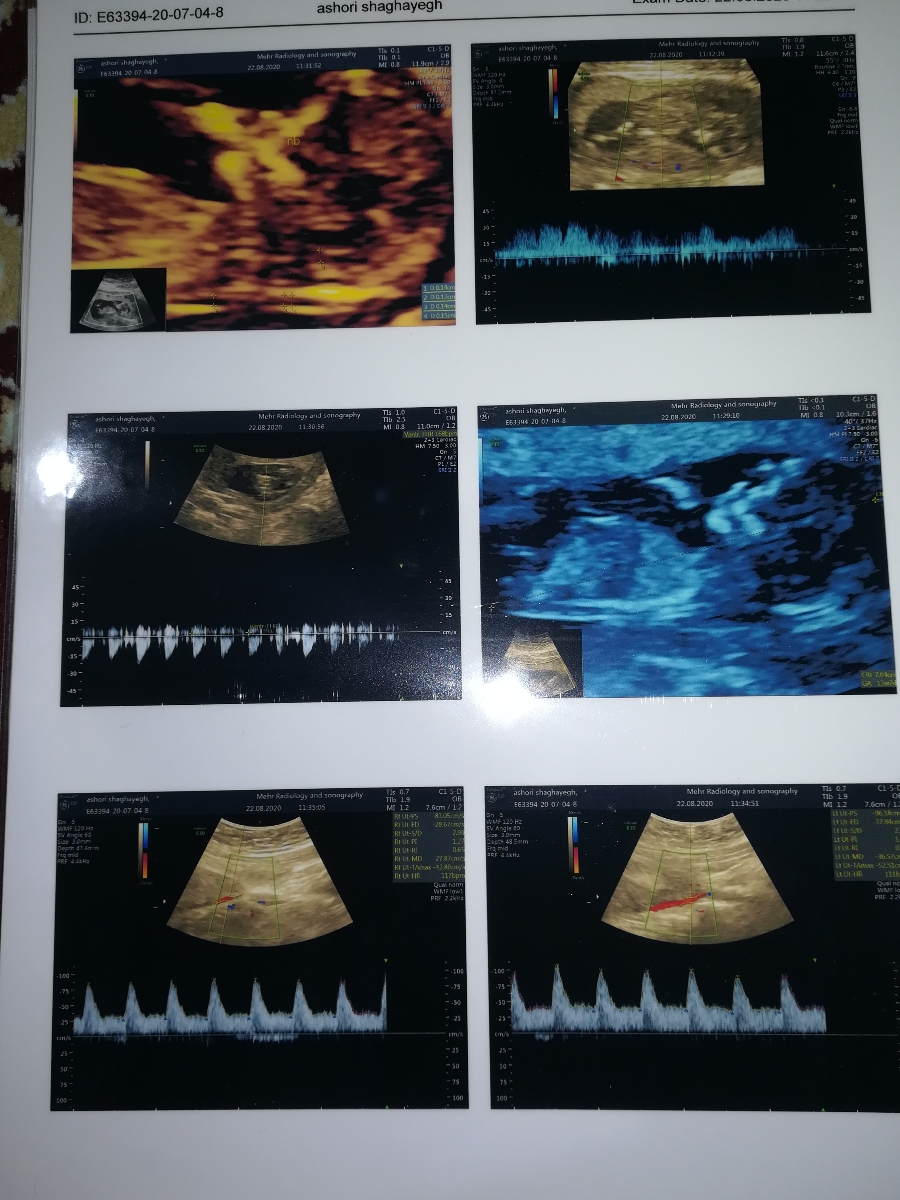 سنوگرافی nt تفسیر 🙏😘
دکتر تفسیر کنید واسم سنو سنوگرافی nt تفسیر 🙏😘
دکتر تفسیر کنید واسم سنو