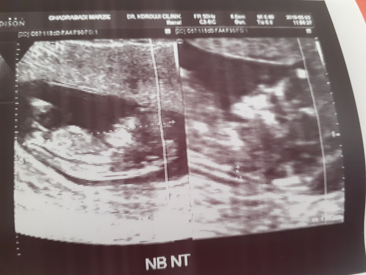 سنوگرافی nt تفسیر 🙏😘
دکتر تفسیر کنید واسم سنو سنوگرافی nt تفسیر 🙏😘
دکتر تفسیر کنید واسم سنو