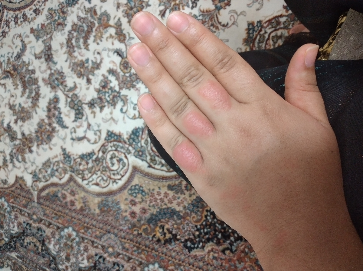 حساسیت ب مواد شوینده