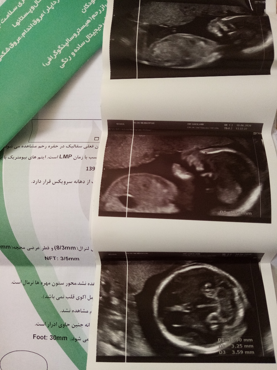 تفسیر سونو آنومالی 🙏🏻 تفسیر سونو آنومالی 🙏🏻