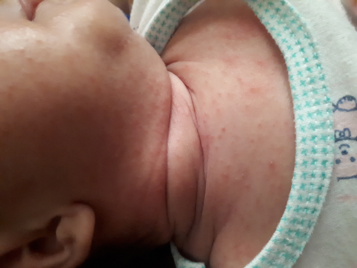 علت جوش بدن نوزاد ۵۰ روزه علت جوش بدن نوزاد ۵۰ روزه