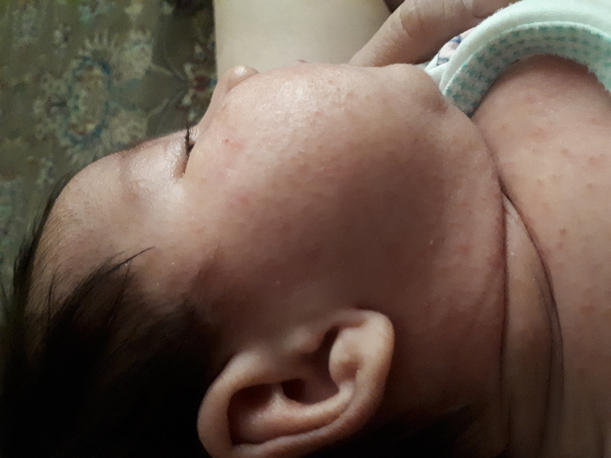 علت جوش بدن نوزاد ۵۰ روزه علت جوش بدن نوزاد ۵۰ روزه