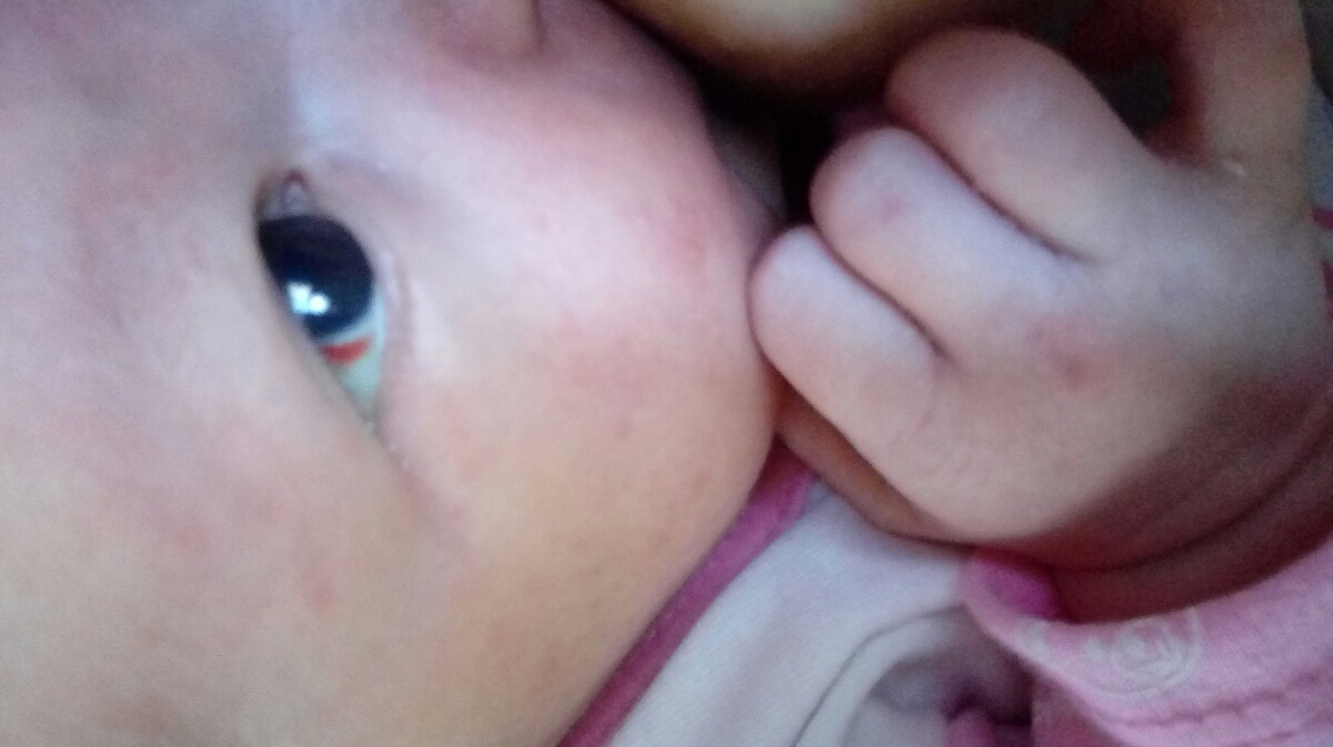 قرمزی چشم نوزاد+ عکس