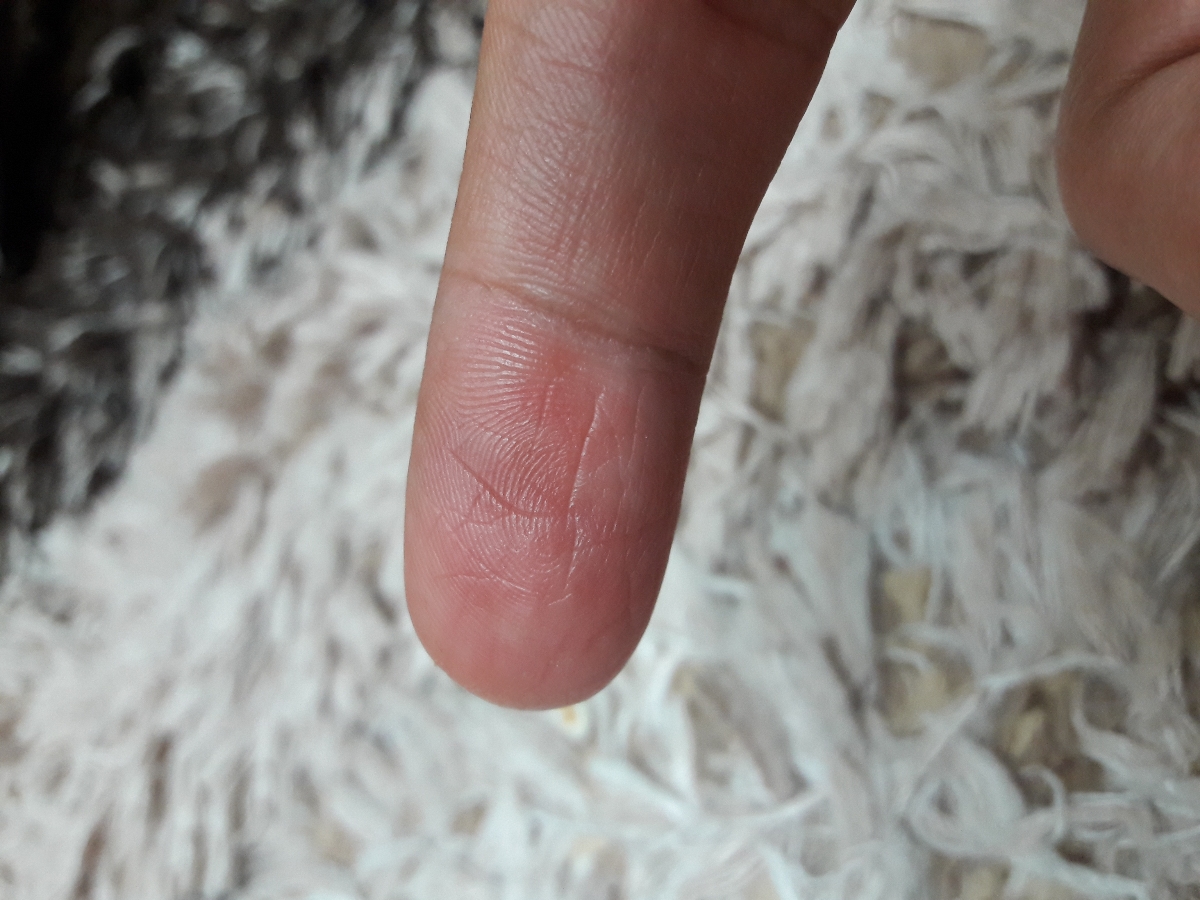 تاحالا کسی انگشتش ایجور شده مث من؟