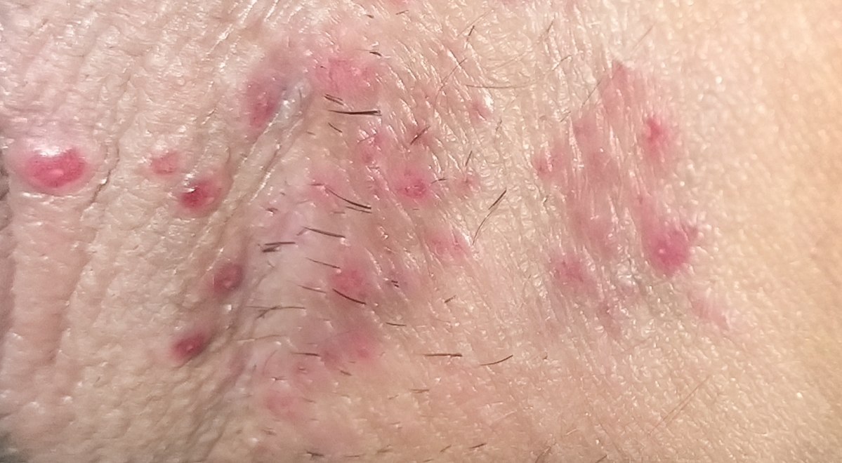 اقدام برای خون بند ناف جنین و داخل تبخال تناسلی