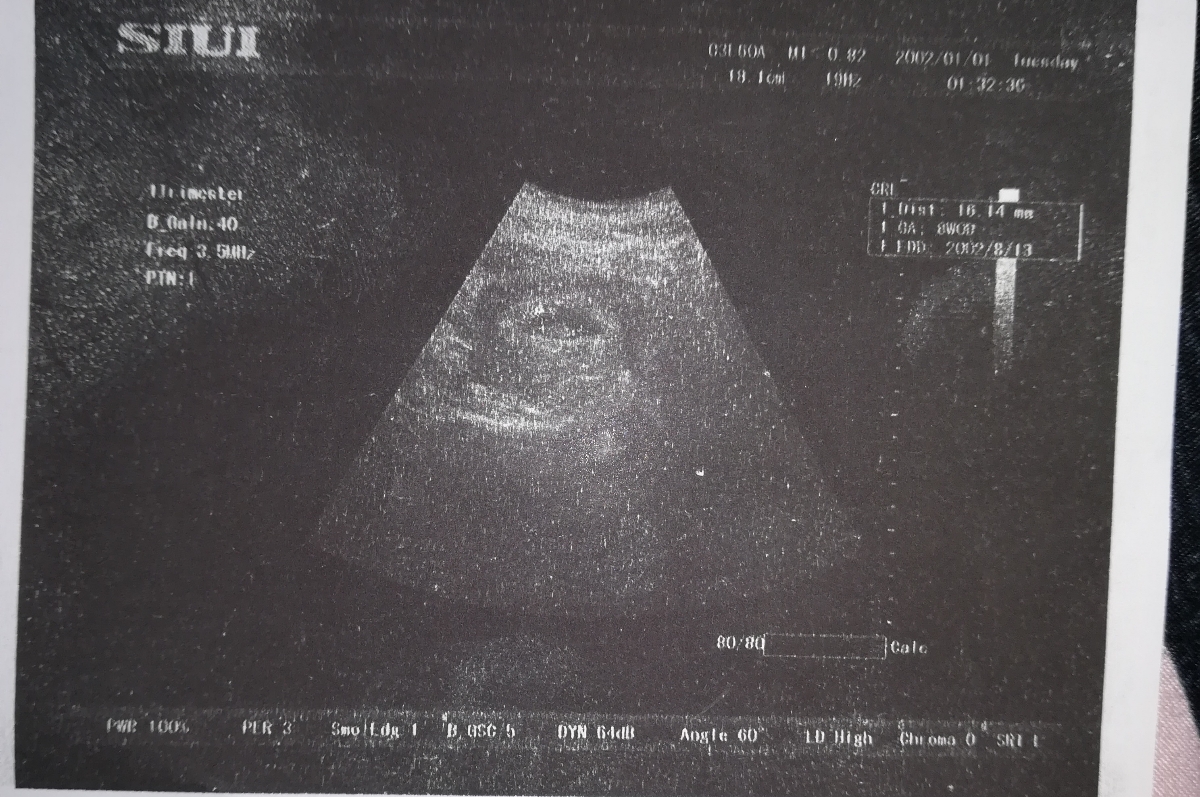 سلام رفتم سونو گفت فیبروم دارم 😢😢😢